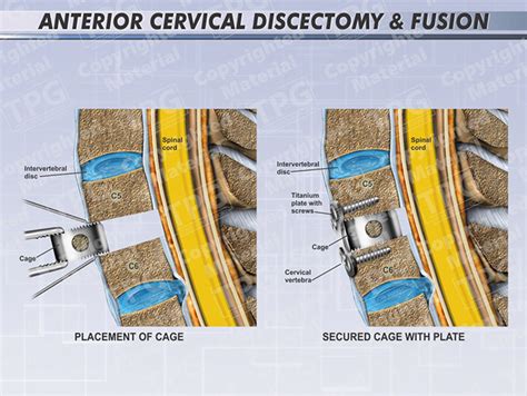 Anterior Cervical Discectomy And Arthrodisc Replacement Order Lupon