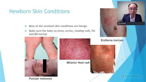 Common Skin Conditions In Children Youtube