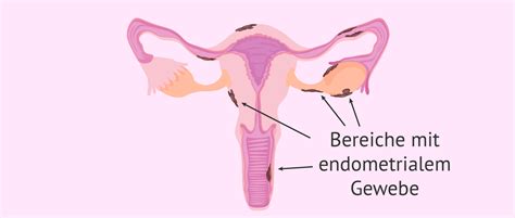 Bei der endometriose befindet sich gebärmutterschleimhaut (endometrium) außerhalb der gebärmutter. Lokalisierung der Endometriose - inviTRA