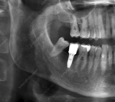 Dental Implant X Ray Stock Image C0403266 Science Photo Library