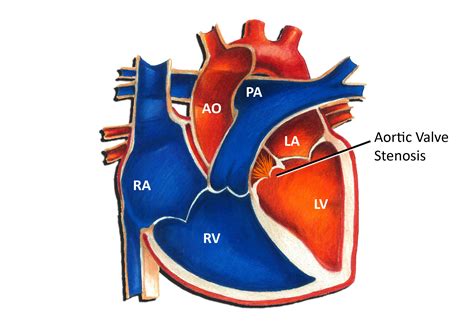 Aortic Valve Stenosis Pediatric Heart Specialists