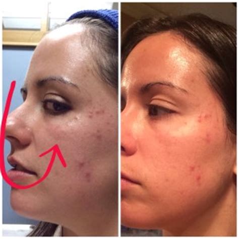 After a chemical peel, you may experience redness and skin sensitivity. Boot Camp Time | The Skinny on Skin