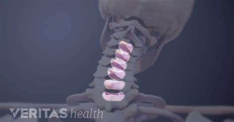 Cervical Disc Definition Back Pain And Neck Pain Medical Glossary