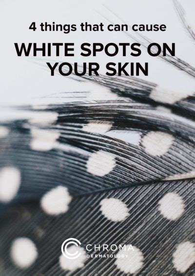 4 Causes Of White Spots On Your Skin