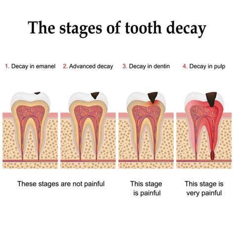 Five Facts About Dental Cavities Clinique Dmd