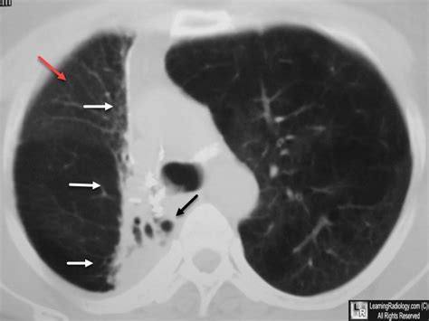 Radiation Fibrosis Radiation Radiology Ct Scan