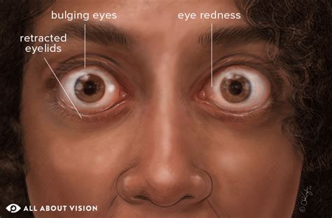 Thyroid Eye Disease All About Vision