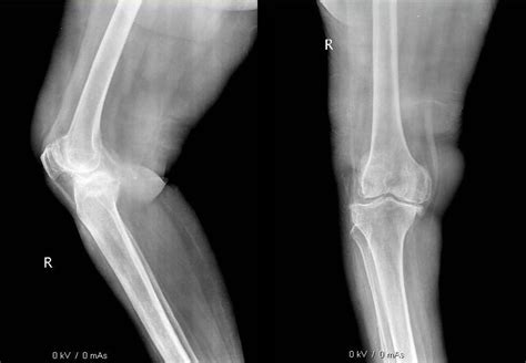 Severe Osteoarthritis Knee With Varus Deformity Download Scientific