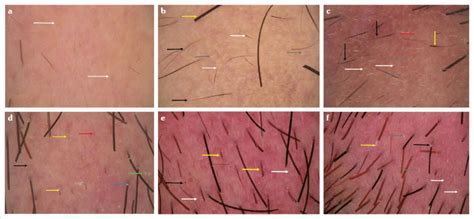 Hair thins over the top of the head and on the sides. a-f. (a) Dermoscopic features of beard alopecia areata ...