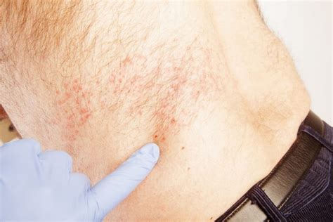 What Are The Symptoms Of Shingles Facty Health