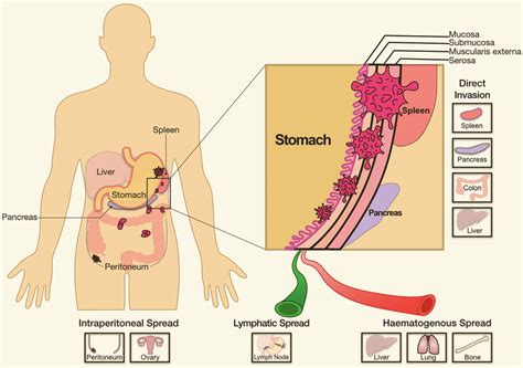 Colon cancer metastasis is also referred to as advanced colon cancer stage iv colon cancer. Metastatic routes and sites in gastric cancer. Major ...