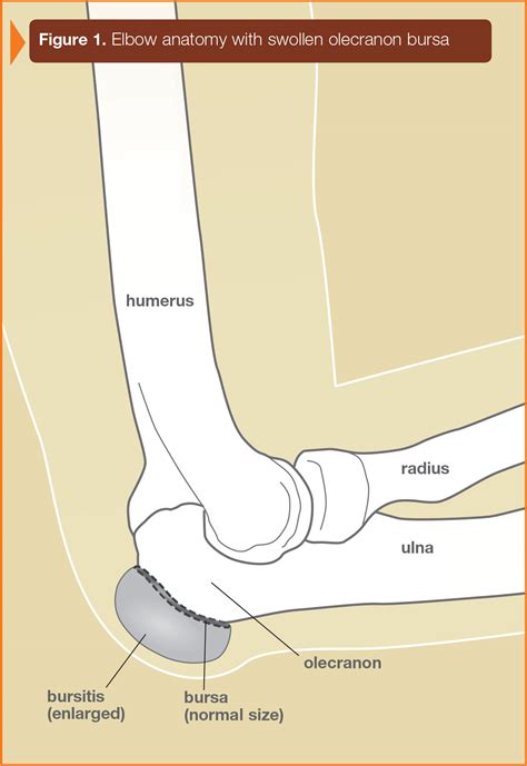 The bony projection of the ulna behind the elbow joint | meaning, pronunciation, translations and examples. Olecranon Bursitis | Ocean Orthopedic Associates