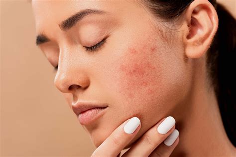 Acne Treatments Brisbane Skin Dermatologist 2022
