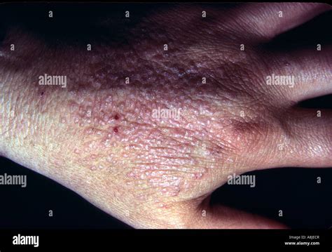 Contact Dermatitis On Hand Eczematous Stock Photo Alamy