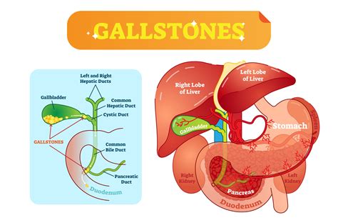 Gallstones And The Need To Consult A Gastroenterologist Immediately