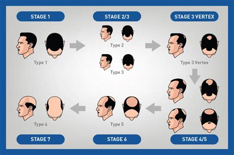 Update More Than 74 Types Of Hair Loss Male Super Hot Ineteachers