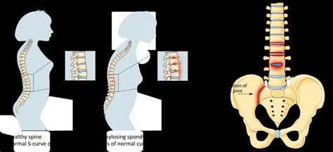 Healthy Spine Compared To Spine With Ankylosing Spondylitis Severe