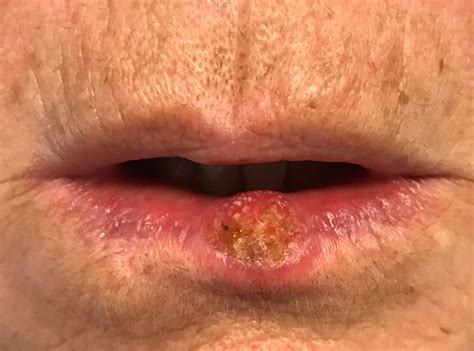 Dermoscopy Of A Squamous Cell Carcinoma Of The Lower Lip Showing