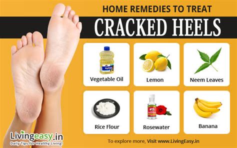 Cracked Heels Remedies Prevention Tips And Care At Home