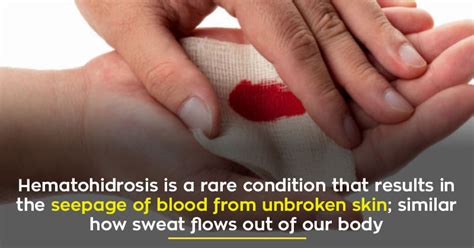 A Rare Condition That Causes People To Sweat Blood Leave Doctors Baffled