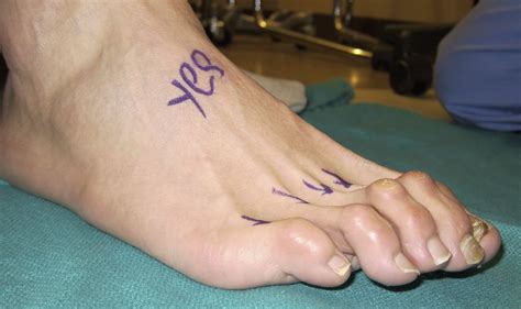 Best Hammertoe Surgeon In Nyc Before And After Pictures