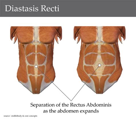 Diastasis Recti Tummy Separation Vanea Posture Pelvic Floor