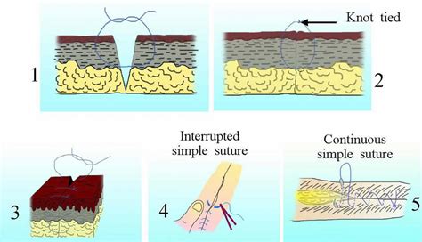 Surgical Suture Types Of Sutures Sizes How To Suture 59 Off