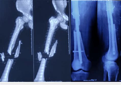 Comminuted Femur Fracture Loss Of Bony Fragment And Interlocking Nail