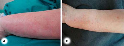 Subcutaneous Sarcoidosis Plaque Located On The Left Forearm A Before