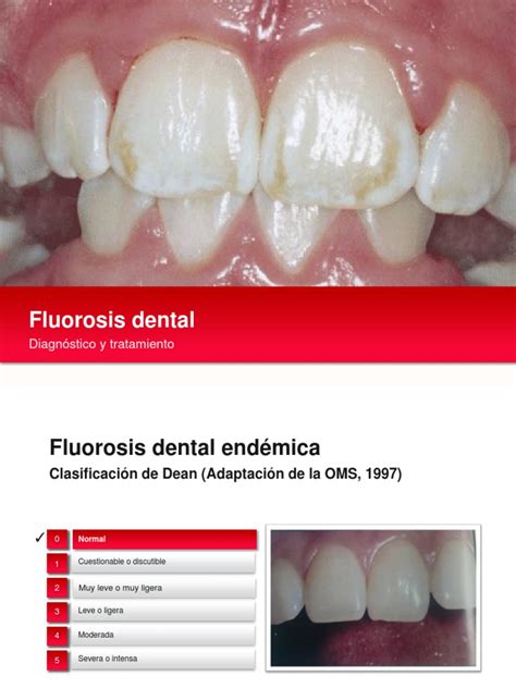 Fluorosis Dental Boca Especialidades Medicas