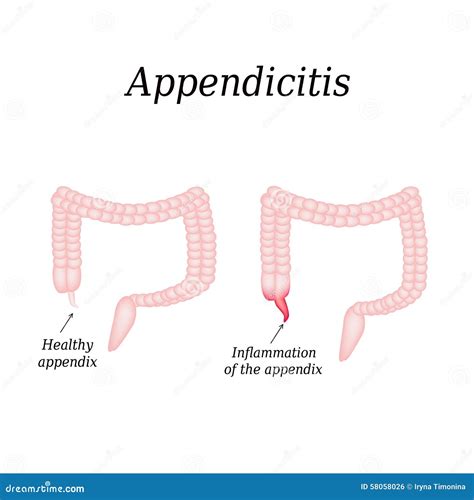 Appendicitis Inflammation Of The Appendix Colon Stock Vector Image