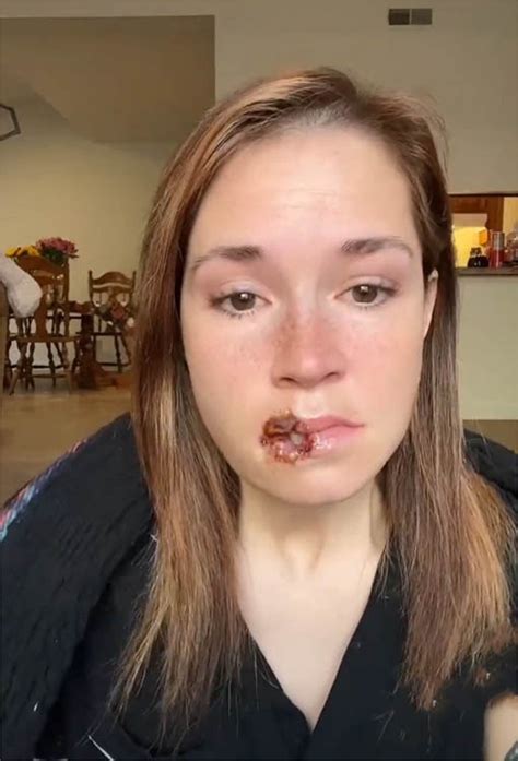 St Louis Mom Scared For Life After Dog Tears Her Lips Off