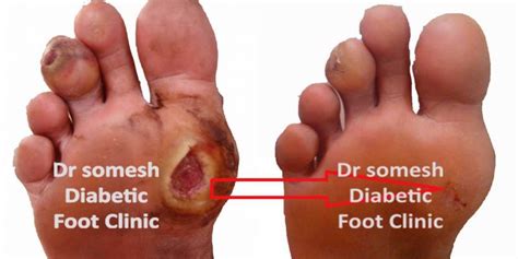 Diabetes Foot Gangrene Stages 1st Metatarsal Head Region Podiatry Doctor