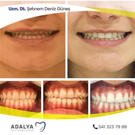 Ortodonti Antalya Di Teli Tedavisi Effaf Plak Nvisalign Tedavisi