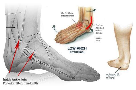 Foot Pain Under Ankle The Complete Diagnosis And Treatment Guide