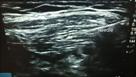 Us Guided Ilioinguinal Iliohypogastric Block Ultrasound Image Of The
