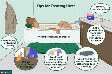 How To Treat Hives Effectively 2023