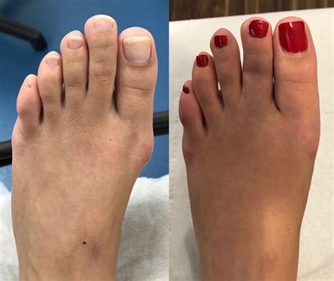 What Is Cosmetic Foot Surgery Gomed