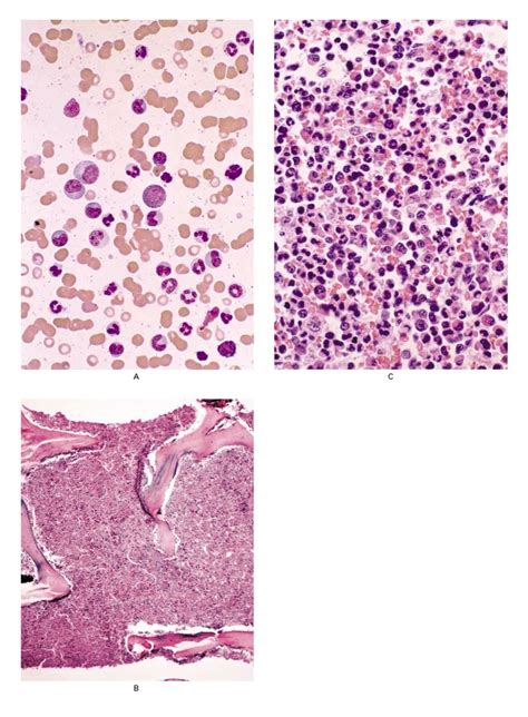 Chronic Myeloid Leukemia Nejm