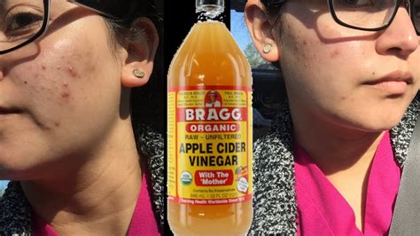 A Whole Week Of Apple Cider Vinegar On My Face To Get Rid Of Acne See