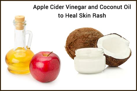 6 Ways To Use Apple Cider Vinegar For Skin Rashes