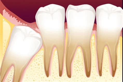 Understanding Wisdom Teeth Can They Really Cause Facial Numbness
