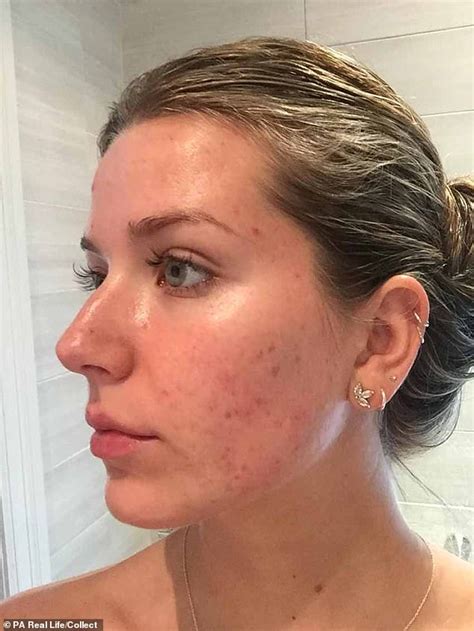 Painful Cystic Acne Left Tennis Stars Sister Too Afraid To Leave The