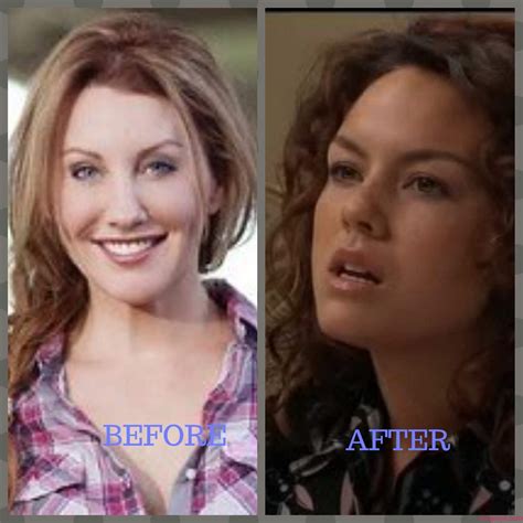 Amy Before And After Surgery