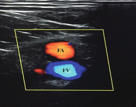 Ultrasound Color Doppler Imaging Of The Right Femoral Artery Fa And