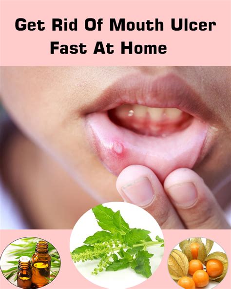 How To Get Rid Of Mouth Ulcer Fast Mouth Ulcers Ulcers Natural