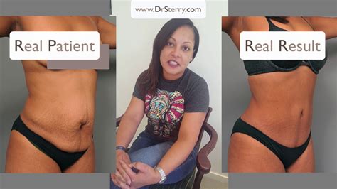 C Section Pain Vs Tummy Tuck Pain Dr Sterry S Patient Compares