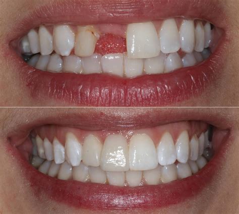 5 Tooth Dental Bridge