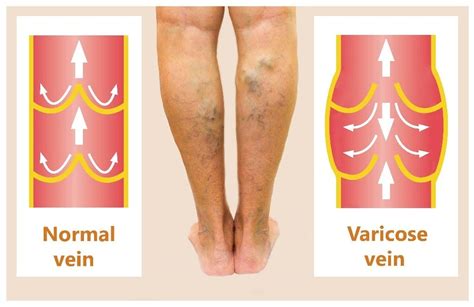 Chronic Venous Insufficiency Signs Symptoms Prevention And Treatment