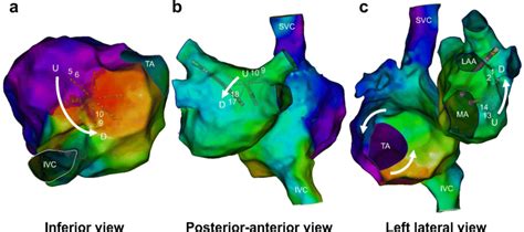 Representative Three Dimensional Activation Maps Of A Common Atrial